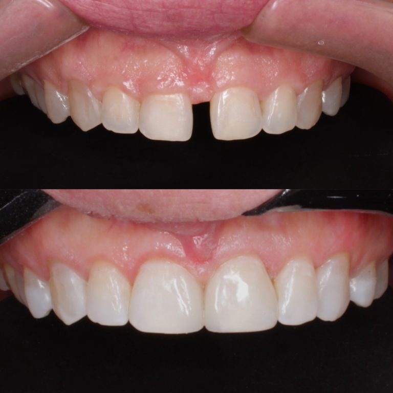 Fechamento de diastema em Dourados-MS com o Dr. Carlos Eduardo Medici Lemos