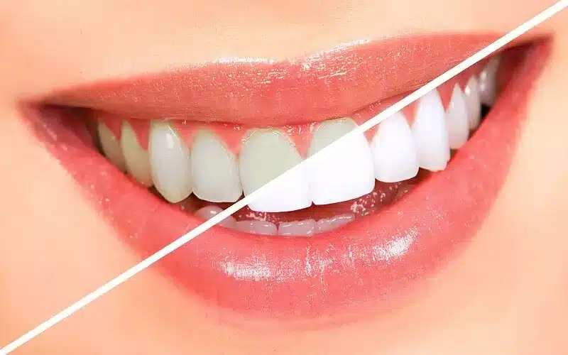 Sorriso branco após clareamento dental realizado pelo Dr. Carlos Eduardo Medici Lemos em Dourados-MS.