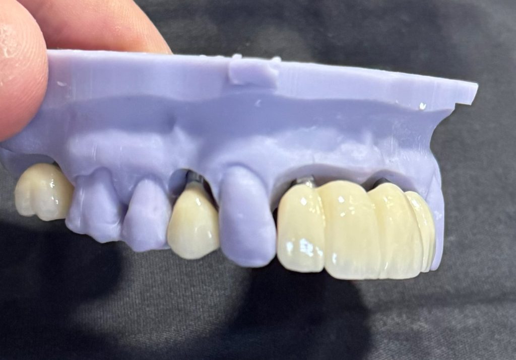 Planejamento digital de implante dentário em Dourados-MS com tecnologia 3D.