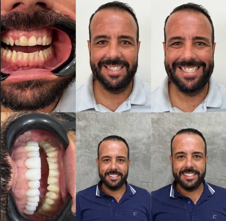 Implante dentário estético em Dourados-MS com resultado natural e harmônico.
