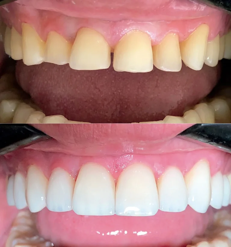 Antes e depois da Reabilitação Oral Estética em Dourados com o Dr. Carlos Eduardo Medice